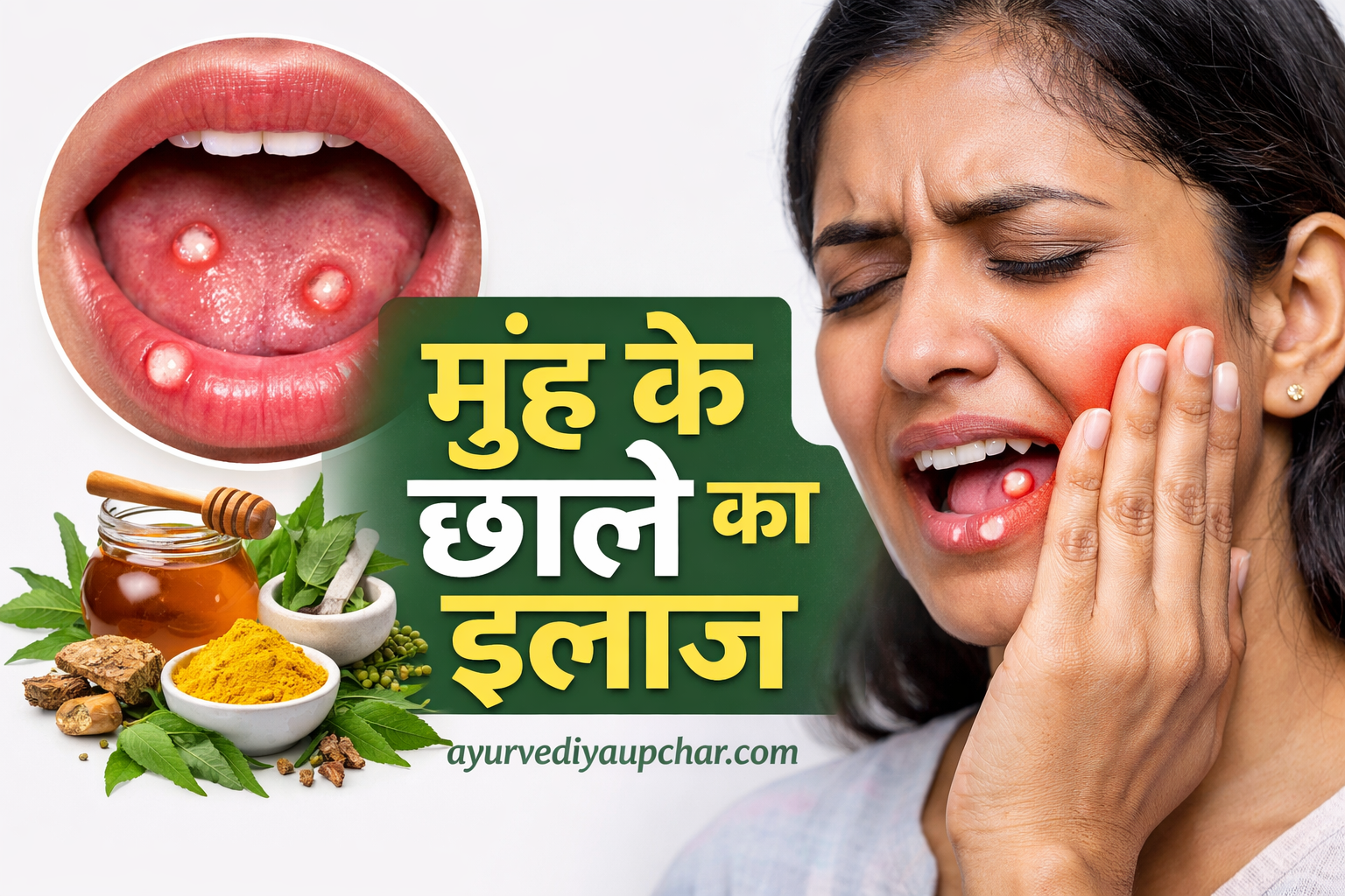 मुंह के छाले: कारण, लक्षण और आयुर्वेदिक घरेलू उपचार