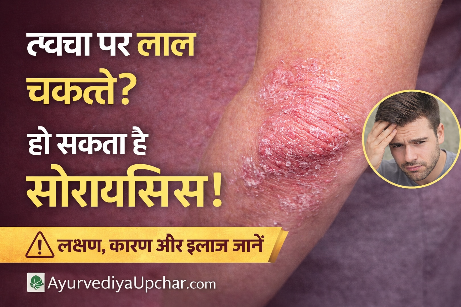 सोरायसिस (Psoriasis) क्या है? कारण, लक्षण, आधुनिक और आयुर्वेदिक उपचार